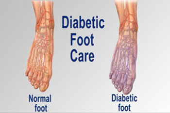 Diabetic foot treatment and care, Diabetic Ulcers Treatment & Management in the Broward County, FL: Fort Lauderdale (Sunrise, Oakland Park, Dania Beach, Lauderhill, Coconut Creek) areas