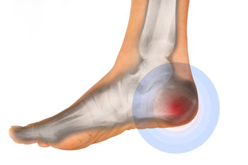 Heel pain treatment in the Broward County, FL: Fort Lauderdale (Sunrise, Oakland Park, Dania Beach, Lauderhill, Coconut Creek) areas