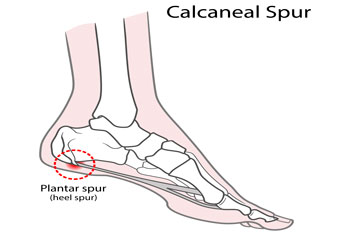 Heel spurs treatment in the Broward County, FL: Fort Lauderdale (Sunrise, Oakland Park, Dania Beach, Lauderhill, Coconut Creek) areas