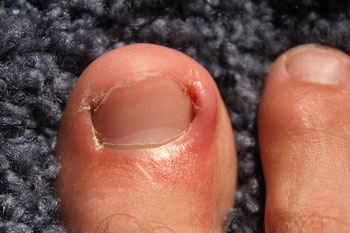 Ingrown toenails treatment in the Broward County, FL: Fort Lauderdale (Sunrise, Oakland Park, Dania Beach, Lauderhill, Coconut Creek) areas