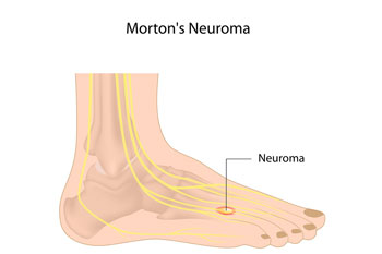 Mortons neuroma treatment in the Broward County, FL: Fort Lauderdale (Sunrise, Oakland Park, Dania Beach, Lauderhill, Coconut Creek) areas