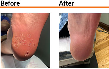 SWIFT Treatment Results Swift before and after condition in the Broward County, FL: Fort Lauderdale (Sunrise, Oakland Park, Dania Beach, Lauderhill, Coconut Creek) areas