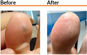SWIFT Therapy for Your Feet Swift before and after condition in the Broward County, FL: Fort Lauderdale (Sunrise, Oakland Park, Dania Beach, Lauderhill, Coconut Creek) areas