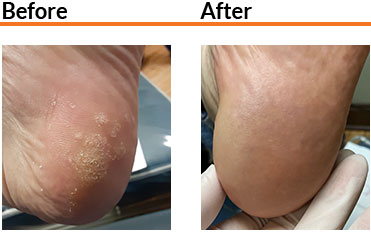 SWIFT Treatment Really Helps Swift before and after condition in the Broward County, FL: Fort Lauderdale (Sunrise, Oakland Park, Dania Beach, Lauderhill, Coconut Creek) areas