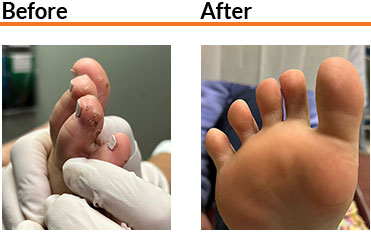 SWIFT Therapy in Work Swift before and after condition in the Broward County, FL: Fort Lauderdale (Sunrise, Oakland Park, Dania Beach, Lauderhill, Coconut Creek) areas