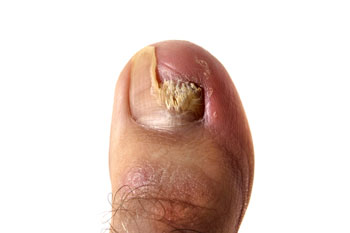 Fungal toenails, toenail fungus diagnosis and treatment in the Broward County, FL: Fort Lauderdale (Sunrise, Oakland Park, Dania Beach, Lauderhill, Coconut Creek) areas