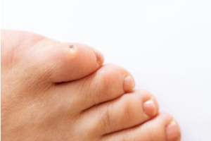 Caring for Corns on Children’s Feet