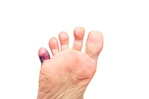 When a Hammertoe Causes Toe Pain